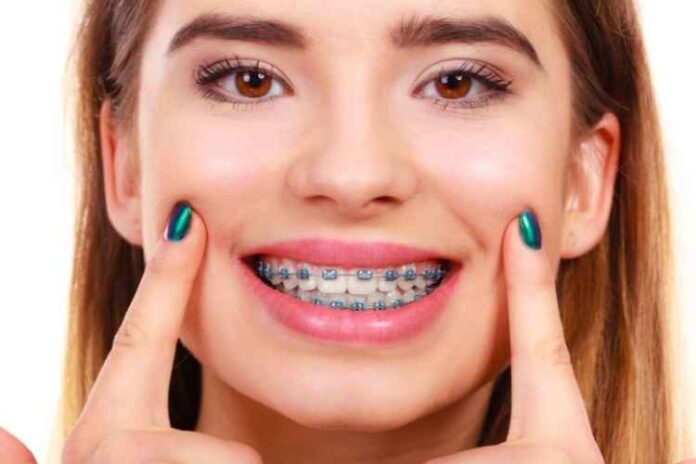 What are bite blocks for braces and how do they help braces?